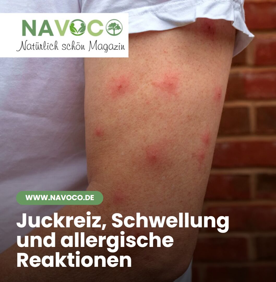 Juckreiz, Schwellung und allergische Reaktionen