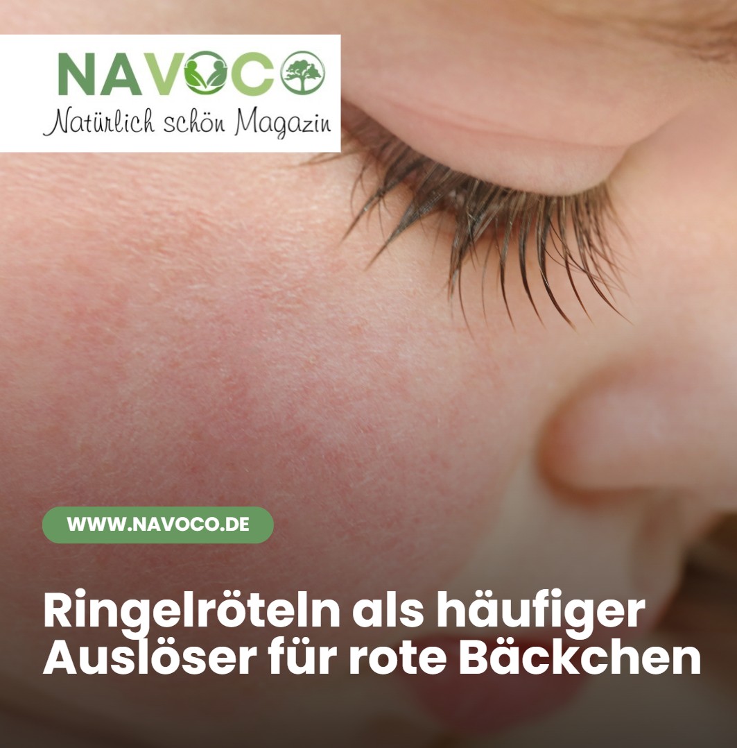 Kind rote Wangen aber kein Fieber Ringelröteln als häufiger Auslöser für rote Bäckchen Kind rote Wangen aber kein Fieber Ringelröteln als häufiger Auslöser für rote Bäckchen